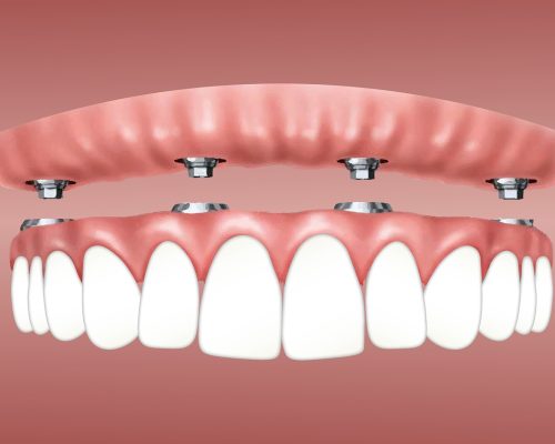 Dentadura-fija-sobre-4-implantes