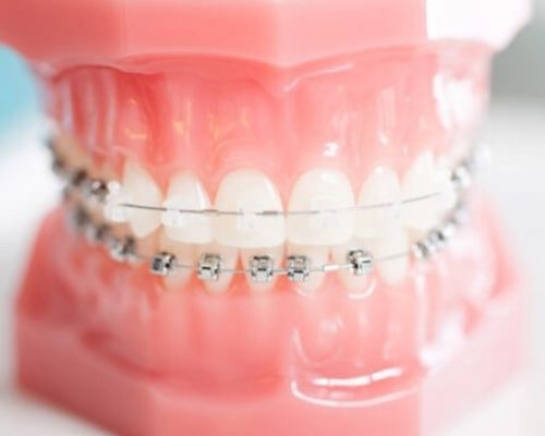 brackets brackets
