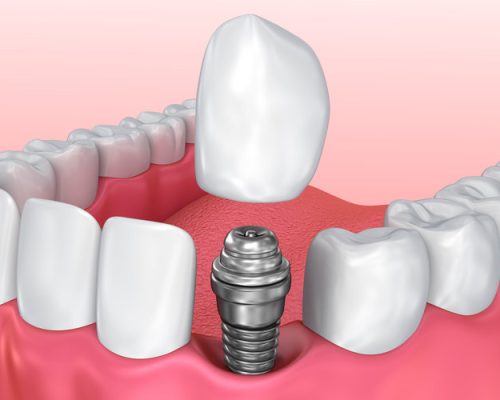 preguntas-sobre-implantes-dentales