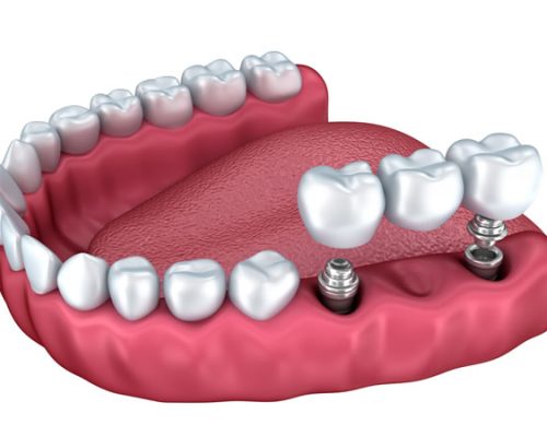 protesis-sobre-implantes